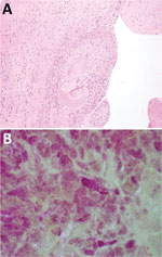 Thumbnail of Results of testing for a 38-year-old man with Coxiella burnetii endocarditis and meningitis, California, USA, 2017. A) Cardiac valve tissue showing fibrous scar and chronic inflammation (hematoxylin and eosin stain, original magnification ×100). B) Numerous clusters of gram-negative cocci are consistent with intracellular organisms (Gram stain, original magnification ×1,000).
