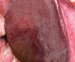 Thumbnail of Gross pathologic view of liver of white-tailed deer no. 44, after experimental infection with Rift Valley fever virus inoculum. The animal died at ay day 3 postinoculation; at necropsy, the liver showed severe, multifocal, hemorrhagic hepatic necrosis attributed to acute infection with Rift Valley Fever virus.