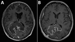 Thumbnail of Images obtained during diagnosis of chagasic encephalitis in 31-year-old man in the United States. A) Contrast-enhanced T1-weighted magnetic resonance imaging of the brain showing a cerebral tumor-like chagoma in the axial plane. B) Follow-up contrast-enhanced T1-weighted magnetic resonance imaging obtained ≈8 weeks later showing improvement of the chagoma.
