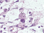 Thumbnail of Tissues obtained during diagnosis of chagasic encephalitis in 31-year-old man in the United States. Touch preparation of brain tissue showing necrotizing encephalitis and abundant Trypanosoma cruzi amastigotes with prominent kinetoplasts (arrows) in astrocytes and macrophages (hematoxylin and eosin stain, original magnification ×600).