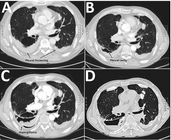 Sequential thoracic computed tomography scan images illustrating the gradual progression from pleural thickening to cavity formation and development of an aspergilloma in a patient with Aspergillus fumigatus infection, Denmark, 2013. A) 2011, B) 2012, C) 2014, D) 2016.