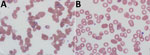 Thumbnail of Peripheral blood films for a 60-year-old woman with probable locally acquired Babesia divergens–like infection, Michigan, USA. A) Before erythrocyte exchange transfusion. Parasitemia was 25%–30%. B) After erythrocyte exchange transfusion. Parasitemia was 3.5%. Original magnification ×1,000.