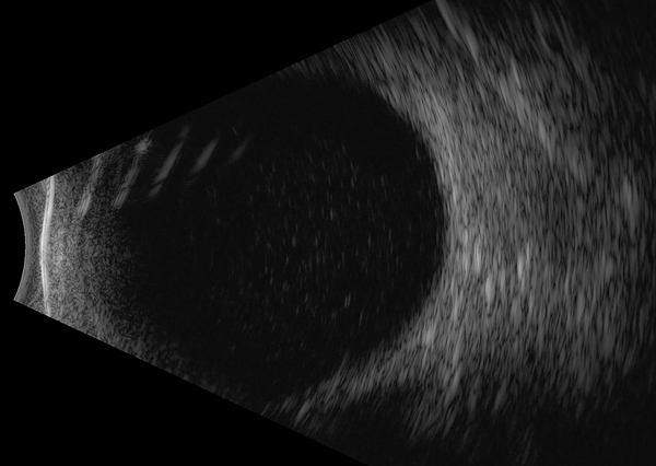 B-scan ultrasonography of the left eye of a 63-year-old woman with Gordonia bronchialis–associated endophthalmitis, Oregon, USA, showing dense opacities in the vitreous space.