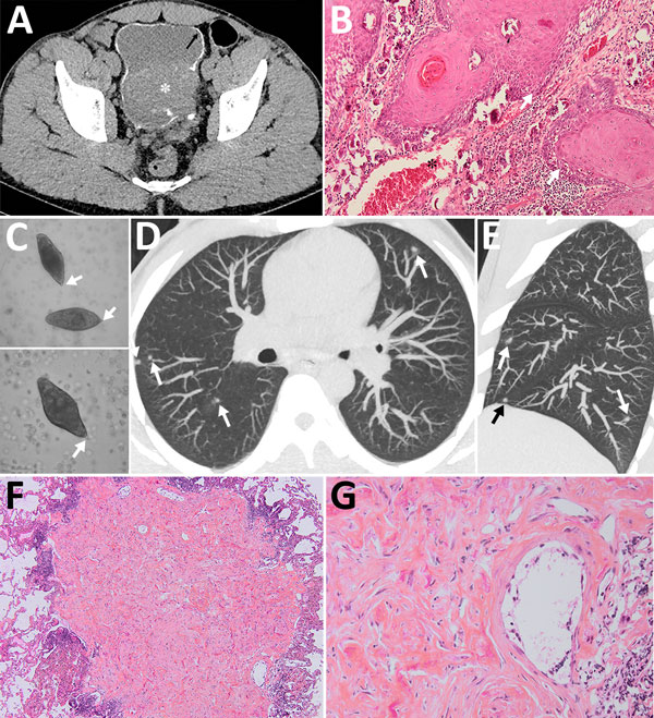 Schistosomiasis-induced squamous cell carcinoma of the bladder with pseudometastatic pulmonary nodules in a 30-year-old man from Mali. A) An unenhanced computed tomography axial image shows diffuse calcification of the wall bladder (arrow). A soft-tissue mass arises from the left posterolateral wall, breaching the calcifications and reaching the perivesical fat (asterisk). B) Anatomopathology slide stained with hematoxylin and eosin (original magnification ×10) of the bladder wall showing massiv