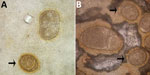 Thumbnail of Abnormalities of Ascaris lumbricoides eggs from patients in the Solomon Islands, visualized on Kato-Katz. A) Giant egg with irregular indented shape. B) Giant egg with 2 morulae. Arrows indicate eggs of normal morphology. Original magnification ×400.