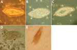 Thumbnail of Abnormalities of Schistosoma spp. eggs visualized in wet preparation. A) Normal S. haematobium egg (≈150 µm long). B) S. haematobium egg with reduced terminal spine. C) S. haematobium egg with irregular, indented shape. D) Normal S. mansoni egg (≈150 µm long). E) S. mansoni egg with 2 lateral spines. Original magnification ×400. Panel E image courtesy of John Goldsmid, University of Tasmania (Hobart, Tasmania, Australia). 