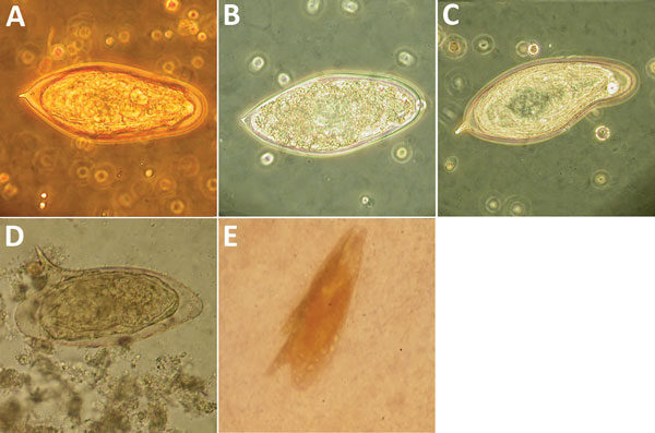 Abnormalities of Schistosoma spp. eggs visualized in wet preparation. A) Normal S. haematobium egg (≈150 µm long). B) S. haematobium egg with reduced terminal spine. C) S. haematobium egg with irregular, indented shape. D) Normal S. mansoni egg (≈150 µm long). E) S. mansoni egg with 2 lateral spines. Original magnification ×400. Panel E image courtesy of John Goldsmid, University of Tasmania (Hobart, Tasmania, Australia). 