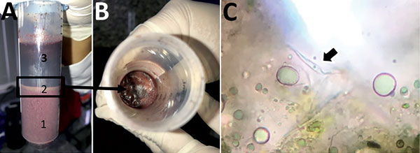 Zçaí berry juice sample from Brazilian Amazon. A) A 50 mL-tube after centrifugation shows 3 layers: 1, pulp, 2, intermediate fat (box); and 3: supernatant. B) Top view of layer 2 (arrow). C) Fresh preparation of layer 2 showing Trypanosoma cruzi flagellated form (arrow).