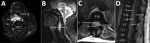 Thumbnail of Magnetic resonance imaging of a 60-year-old immunocompetent man with methicillin-resistant Staphylococcus aureus clonal complex 398 infection. A, B) Axial (A) and sagittal (B) T2-weighted fat suppressed sequences of the cervical spine demonstrate a retropharyngeal abscess (1) that moderately anteriorly displaces and mildly effaces the hypopharynx (2). C, D) Axial (C) and sagittal (D) T2-weighted MRI sequences of the thoracolumbar spine (T11–L2 vertebra levels labeled) demonstrate a 