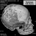 Thumbnail of Volume rendering of the skull of Maria Salviati, showing contemporary presence of lytic (superficial cavitations) and reparative lesions (radial scars).(Archive of the Division of Paleopathology. University of Pisa.) 