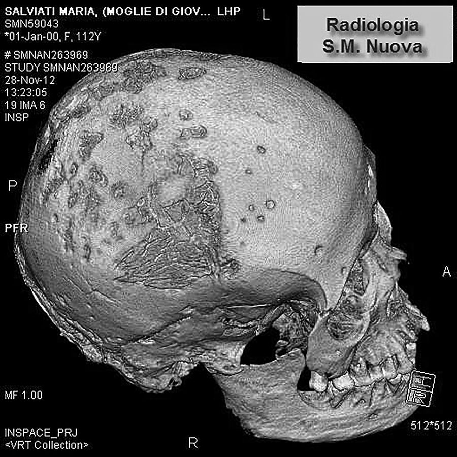 Volume rendering of the skull of Maria Salviati, showing contemporary presence of lytic (superficial cavitations) and reparative lesions (radial scars).(Archive of the Division of Paleopathology. University of Pisa.) 