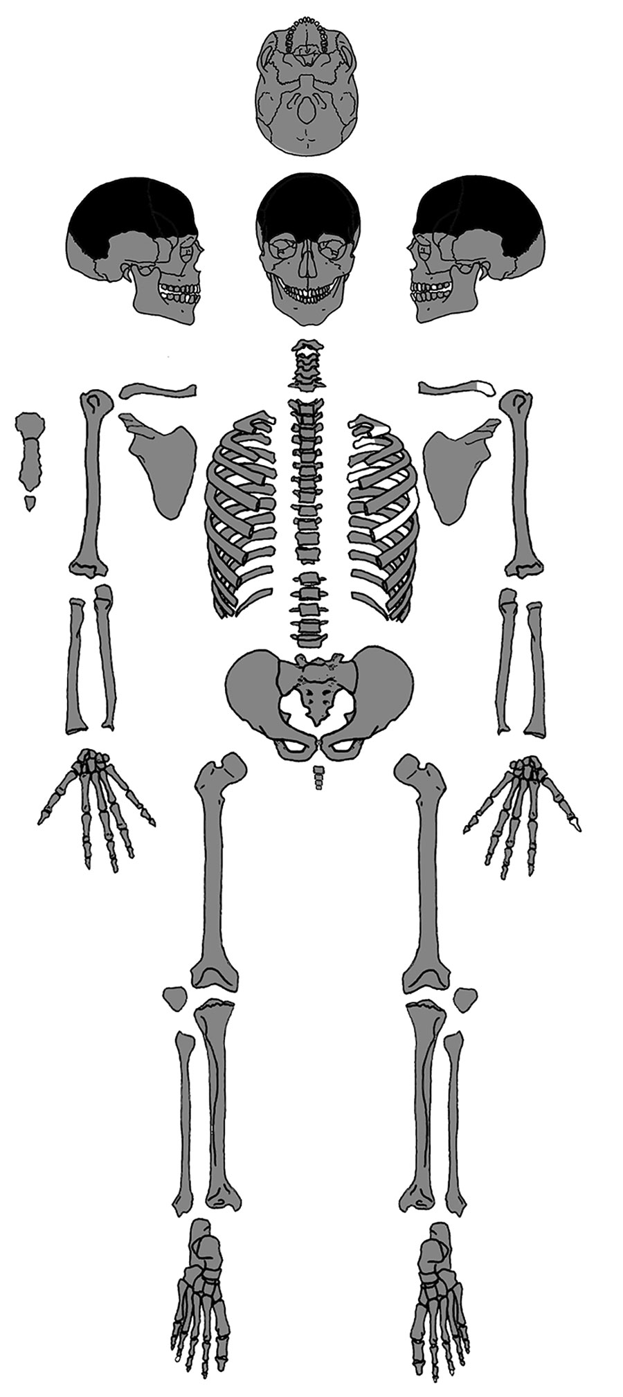 Present-day bones of the skeleton of Maria Salviati (gray). Distribution of lesions (black). (Archive of the Division of Paleopathology. University of Pisa.) 