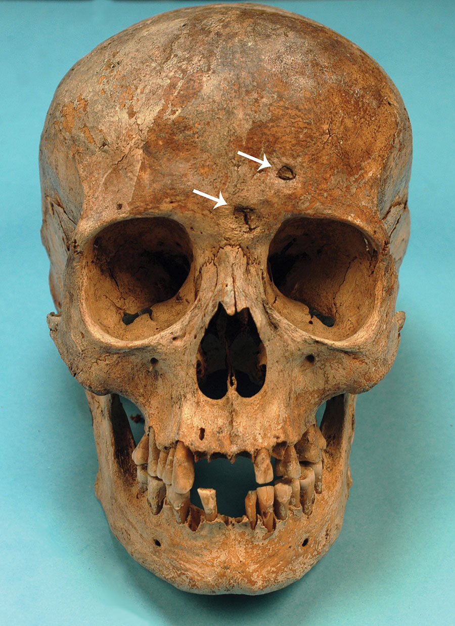 The skull of Maria Salviati in frontal view. Cavitations on the frontal bone are apparent. (Archive of the Division of Paleopathology. University of Pisa.) 