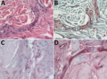 Thumbnail of Photomicrographs showing hematoxylin and eosin stain and immunohistochemical findings, using assays targeting the cell wall and capsule of Bacillus anthracis, in ear-punch biopsy specimens from a hippopotamus infected with B. anthracis, Bwabwata National Park, Namibia, 2017. A) Hematoxylin and eosin stain showing large bacilli evident in vessel lumen. Original magnification × 40. B) Gram stain showing gram-variable rods evident in vessels. Original magnification × 40. C) Immunohisto