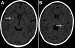 Thumbnail of Cerebral computed tomography images of infant with probable congenital Zika virus infection at 7 months of age, Brazil. A) Mild calcifications at the right lenticular nucleus (arrow); B) calcifications at the posterior arm of the left internal capsule (arrow).