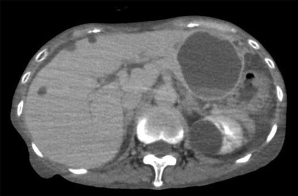 Enhanced computed tomography image showing a large hepatic cyst (63 mm in diameter) on the left liver lobe in a patient with Helicobacter cinaedi infection on the day of hospital admission, Tokyo, Japan, July 2017.