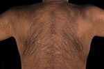Thumbnail of Back of case-patient A showing scarring from self-flagellation, United Kingdom.