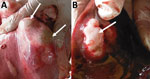Thumbnail of Lung (A) and liver (B) parenchyma infected with hydatid cysts (white arrows) detected during veterinary inspection at slaughterhouse and before the entire organ was confiscated and destroyed by incineration, Huancayo Province, Peru.