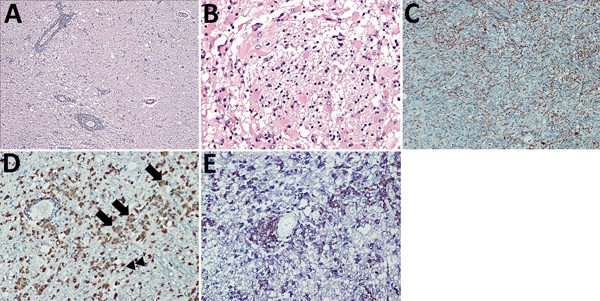 Brain inflammation in patients with fatal variegated squirrel bornavirus 1 encephalitis. A) Brain section showing mononuclear cell infiltration and tissue edema. Hematoxylin and eosin stain; original magnification ×100. B) Depiction of glial cell activation in a brain biopsy sample of malacia. Astrocytes appear bizarre and enlarged. Hematoxylin and eosin stain; original magnification ×400. C) Demonstration of glial fibrillary acidic protein (GFAP). Immunoperoxidase stain with hematoxylin counter