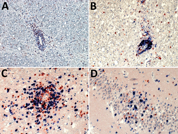 Demonstration of neutrophils, B cells, and CD4+ and CD8+ T-lymphocyte infiltration of the brain parenchyma during variegated squirrel bornavirus 1 infection. A) Demonstration of CD177+ neutrophils infiltrating the brain parenchyma from a blood vessel. Neutrophils are also seen scattered throughout the tissue during the infection. Immunoperoxidase stain with hematoxylin counterstain; original magnification ×200. B) Depiction of B cells (CD20, blue) and T cells (CD3, red) around a blood vessel. B 