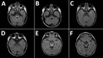 Thumbnail of Magnetic resonance images of the brain of a 2-year-old boy with enterovirus meningoencephalitis. A–C) Brain at time of diagnosis. FLAIR sequences show hyperintense lesions around ventricle IV (A), posterior region of the pons (B), and posterior region of the mesencephalon (C). D–F) Control images of cerebrum 6 months after diagnosis. FLAIR sequences show slight hyperintensity of signal around ventricle IV, lower than in the initial study (D), and complete resolution of lesions in th