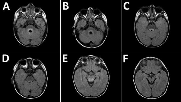 Magnetic resonance images of the brain of a 2-year-old boy with enterovirus meningoencephalitis. A–C) Brain at time of diagnosis. FLAIR sequences show hyperintense lesions around ventricle IV (A), posterior region of the pons (B), and posterior region of the mesencephalon (C). D–F) Control images of cerebrum 6 months after diagnosis. FLAIR sequences show slight hyperintensity of signal around ventricle IV, lower than in the initial study (D), and complete resolution of lesions in the posterior r