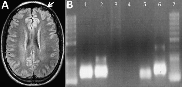 Imaging and PCR results for a 28-year-old man with Oropouche virus infection, southeastern Brazil. A) Cerebral computed tomography showing a cortical edema on the left frontal lobe (white arrow). B) Agarose gel of reverse transcription PCR products of Oropouche virus S fraction. Lane 1, patient’s serum sample; lane 2, patient’s cerebrospinal fluid; lane 3, patient’s leukocyte supernatant; lane 4, negative control; lane 5, internal control; lane 6, positive control.