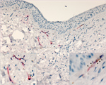 Thumbnail of Lassa virus (LASV) targeting endothelial cells in the eye in study of LASV targeting of anterior uvea and endothelium of cornea and conjunctiva in eye. Co-staining for LASV antigen (red) and platelet endothelial cell adhesion molecule (an endothelial marker, brown) in vessels at the margin of the cornea and within the conjunctiva show colocalization of LASV and endothelial antigens (arrowheads). Original magnification ×10; insets enlarged to ×63.