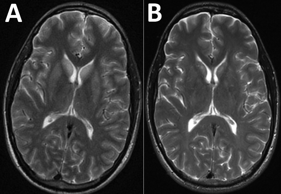 Magnetic resonance imaging (MRI) of the brain of a patient with encephalitis caused by Powassan virus, Massachusetts, USA, 2017. A) Initial brain MRI showing high T2 signal abnormality in the bilateral caudate and putamen. B) Noticeable improvement on repeat brain MRI 2 weeks later.