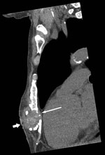 Thumbnail of <!-- INSERT SHAPE --><!-- INSERT SHAPE -->Figure. Computed tomography scan of the chest wall (sagittal section, bony windows) of man from Kenya with Candida auris sternal osteomyelitis, Australia, 2015. Image shows bony erosion and fragmentation of distal sternum (thin arrow), together with a 3.3-cm abscess and a sinus tract in the subcutaneous tissues (thick arrow).