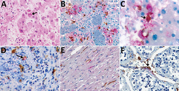 Immunohistochemical stains of tissue from patients with fatal cases of Ebola virus (EBOV) disease showing EBOV (red) and CD163 (brown) antigens. A) Hematoxylin and eosin stain of liver showing hepatocellular necrosis with intracytoplasmic eosinophilic inclusions (arrow). B) EBOV antigens in hepatocytes and CD163 antigens in macrophages. C) High magnification image of double immunohistochemical staining of liver tissue showing colocalization of EBOV and CD163 antigens in macrophage (arrow). D) Co