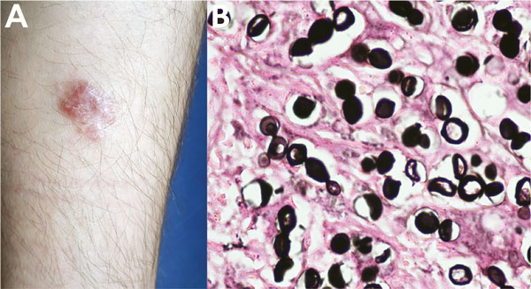 Lobomycosis in a 28-year-old soldier (case-patient 1), Colombia. A) Erythematous papules that became confluent and formed an infiltrated plaque with kelodial aspect, smooth surface, located on the middle third of the right leg. B) Grocott-Gomori staining of a biopsy specimen from the lesion shows chains of yeast, some of them in the budding process. Periodic acid–Schiff stain shows yeast of uniform size with a thick cell wall and clear cytoplasm (original magnification ×40).