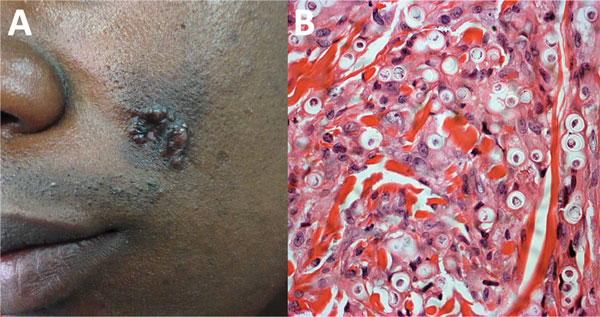 Lobomycosis in a 40-year-old soldier (case-patient 4), Colombia. A) Phototype V lesion on the left cheek with papules that became confluent and formed a lobulated plaque with a smooth and shiny surface. B) Periodic acid–Schiff staining of a biopsy specimen from the lesion shows multiple yeasts of uniform size, and thick walls are seen inside phagocytoses (original magnification ×40).