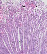 Thumbnail of Section of large intestine from a pig infected with Salmonella enterica subsp. enterica serotype I 4,[5],12:i:-. Asterisk indicates crypt elongation and goblet cell loss, arrow indicates abundant degenerate neutrophils in the lumen, and arrowhead indicates abundant fibrin in the lumen. Hematoxylin and eosin stain, original magnification ×100.