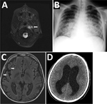 Thumbnail of Most relevant imaging results from a 16-year-old boy with X-linked chronic granulomatous disease who died of meningitis caused by a virulent Granulibacter bethesdensis strain. A) Computed tomography image showing deep cervical abscess (arrow), July 2012. B) Radiograph showing pneumonia with pleural effusion, October 2012. C) Cranial magnetic resonance image showing multiple intraparenchymal brain abscesses (arrows), December 2012. D The patient died of obstructive hydrocephalus (sho