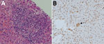 Thumbnail of Histology of tissue from liver graft of hepatitis E virus case-patient 1, a 66-year-old man, on posttransplantion day 122. A) Hematoxylin and eosin staining showing moderate (grade 2) inflammation. B) Immunohistochemical staining (using hepatitis E virus monoclonal antibody); arrow indicates small groups of hepatocytes with positive cytoplasmic signals.
