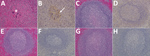 Thumbnail of Results of testing for Nipah virus (NiV) in spleen tissue from representative vaccinated African green monkeys (Chlorocebus aethiops). A, C, E, G) Hematoxylin and eosin staining; B, D, F, H) immunohistochemistry of tissues labeled with NiV N protein–specific polyclonal rabbit antibody. In stained tissue from the control animal (A), moderate necrosis and drop of out the white pulp (*), with hemorrhage, and fibrin within germinal centers are seen; stained sections examined from the Ni