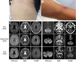 Thumbnail of Clinical manifestations and cerebral magnetic resonance imaging of a 66-year-old man with Rickettsia sibirica mongolitimonae–associated encephalitis, southern France, 2018. A) Maculopapular rash. B) Black eschar and rope-like lymphangitis on the right leg. C) Magnetic resonance imaging with diffusion (B1000), ADC, and FLAIR. In July 2018, cytotoxic lesions were observed intra-axially and in the white matter of right cerebellar hemispheres with FLAIR hypersignal and with low ADC sign