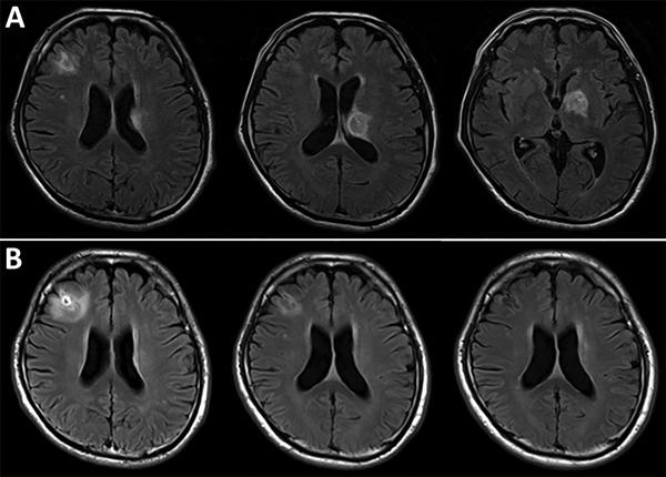 Serial brain magnetic resonance imaging results for a 57-year-old man with Toxoplasma gondii encephalitis, Tokyo, Japan. A) All 3 lesions were evident when the patient first sought care. B) Chronologic changes are shown of the lesion in the right frontal lobe in response to antitoxoplasmic therapy after 1 (left), 3 (center), and 12 (right) months.