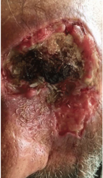 Thumbnail of Ophthalmomyiasis caused by live larvae of Chrysomya bezziana in 75-year-old man, Iran.