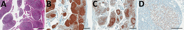 Identification of primary effusion lymphoma and immunohistochemical staining of primary effusion lymphoma cells with Kaposi’s sarcoma–associated herpesvirus latent nuclear-associated antigen (LANA)–specific antibody. A) Diffuse infiltration of the pleura pulmonalis and pleural space with pleomorphic round cells resembling primary effusion lymphoma. Hematoxylin and eosin stain; scale bar indicates 400 μm. B) The neoplastic cells are lymphocytic cells of B cell origin. CD20 immunohistochemistry; s