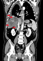 Thumbnail of Computed tomography scan of a patient diagnosed with alveolar echinococcosis, Croatia. Arrows indicate right pleural effusion, lung lesions, an enlarged right adrenal gland, and a 13 × 12 × 12 cm lesion in the liver caused by Echinococcus multilocaris.