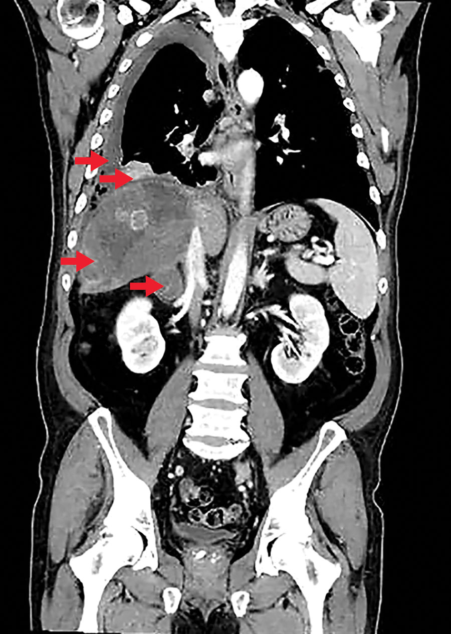 Computed tomography scan of a patient diagnosed with alveolar echinococcosis, Croatia. Arrows indicate right pleural effusion, lung lesions, an enlarged right adrenal gland, and a 13 × 12 × 12 cm lesion in the liver caused by Echinococcus multilocaris.