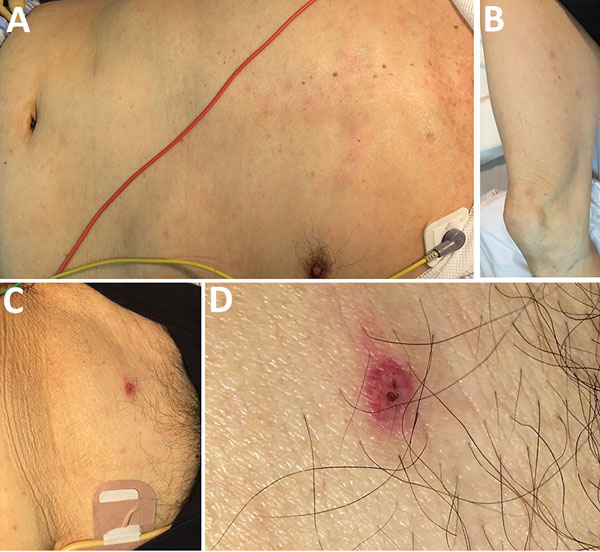 Patient with Rickettsia japonica infection after being bitten by a land leech, Japan. A, B) Erythematous macular rash on the patient’s torso (A) and extremities (B); C, D) eschar on the lower abdomen showing an atypical appearance with a relatively well-demarcated boundary of erythema with a tiny scab.