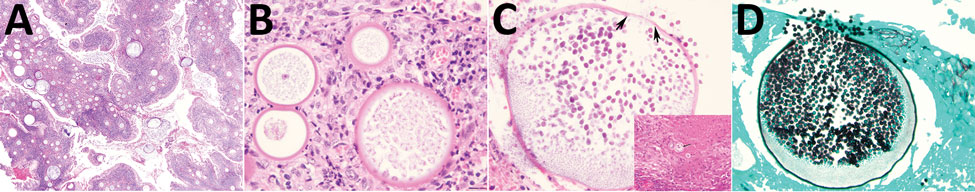 Histopathologic characteristics of rhinosporidiosis, Eastern Province, Rwanda, 2014–2016. A) At scanning magnification, multiple cystic structures (sporangia) of variable sizes are embedded in respiratory mucosa in a background of mononuclear inflammation (hematoxylin and eosin [H&amp;E] stain; original magnification ×40). B) R. seeberi early juvenile sporangium, with a well-delimited cell wall, granular cytoplasm, and reddish nucleus with prominent nucleolus, characteristic of this stage (H&amp