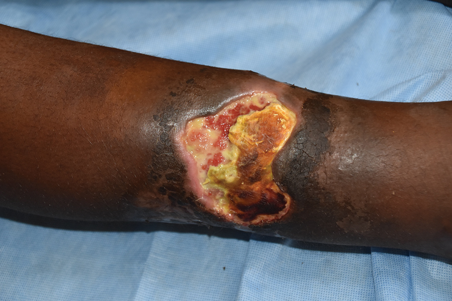 Typical Buruli ulcer lesion on the arm of a patient from Ghana. Central necrosis, yellowish-white slough, and undermined edges surround the wound. Photo courtesy of T.S. van der Werf.