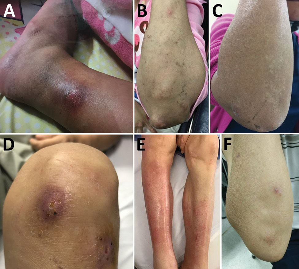 Cutaneous manifestation in non-HIV–infected patients infected with Mycobacterium haemophilum, Bangkok, Thailand. A) Patient 9, B) patient 11, C) patient 12, D) patient 16, E) patient 17, F) patient 21.