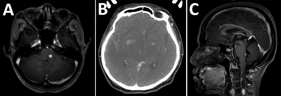 Imaging of brain and spine of 3 patients infected with Mycobacterium haemophilum who had involvement of the central nervous system, Bangkok, Thailand. A) Patient 1, axial T1-weighted magnetic resonance imaging scan with gadolinium showing enhanced nodule at left dorsal pons. B) Patient 2, axial contrast-enhanced computed tomography scan showing hypodensity lesions in both thalami and nodular enhancement at the bilateral basal ganglia. C) Patient 3, sagittal T1-weighted magnetic resonance imaging