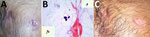 Thumbnail of Patient with blastomycosis, India, 2014. A) Photograph of chest showing actively discharging sinuses before treatment with antifungal medication. B) Histopathology slide of Gram-stained pus discharge, showing broad-based budding yeast cells. The insets show Gram staining of the same organism, with narrow and broad-based budding in different fields. Original magnification ×100. C) Photograph of chest showing closed sinuses and disappearance of sinus line after treatment with antifung