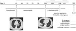 Thumbnail of Evolution of fungal biomarkers, computed tomography chest scans, and antifungal treatments for immunocompromised patient 1 with invasive Aspergillus fumigatus infection, France, 2018. Arrows indicate lesions. qPCR, quantitative PCR.